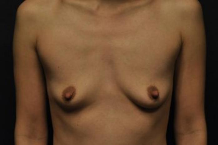 Case #1252 – Breast Augmentation