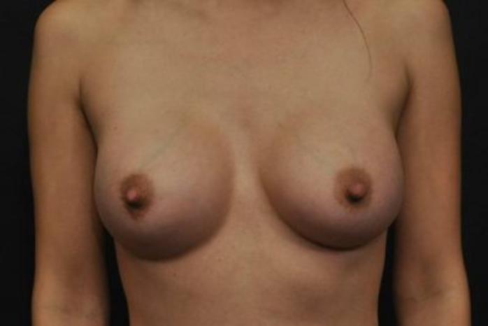 Case #1252 – Breast Augmentation
