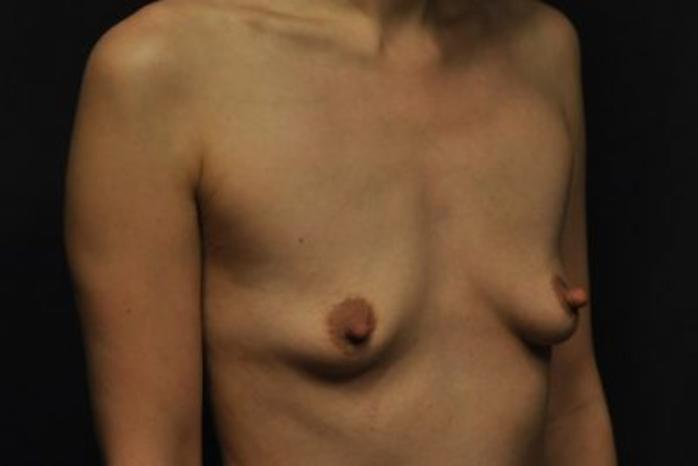 Case #1252 – Breast Augmentation