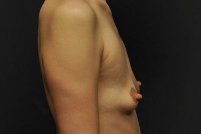 Case #1252 – Breast Augmentation