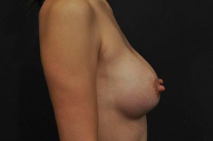 Case #1252 – Breast Augmentation