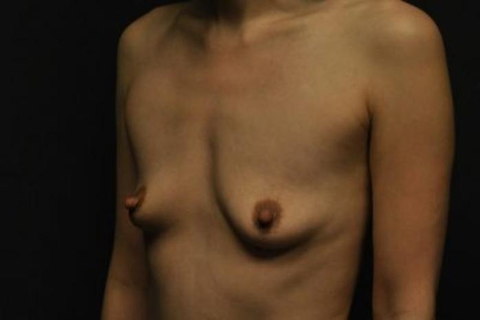 Case #1252 – Breast Augmentation