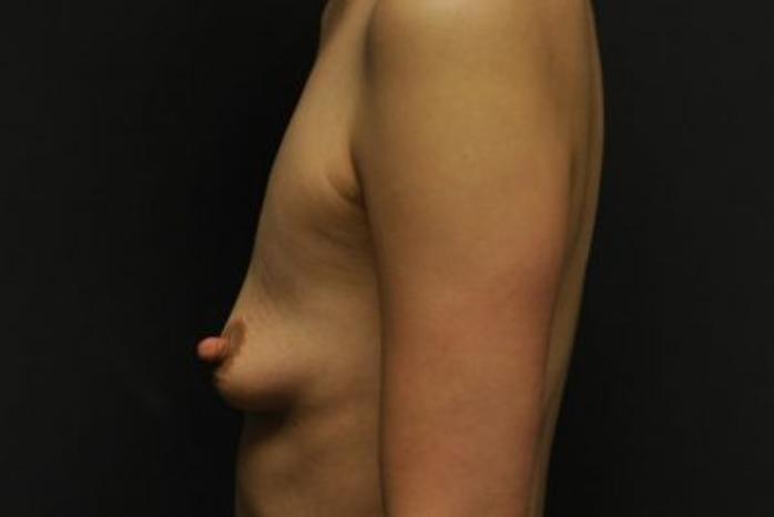 Case #1252 – Breast Augmentation