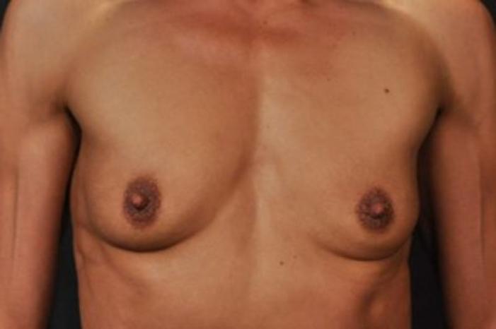 Case #1264 – Breast Augmentation
