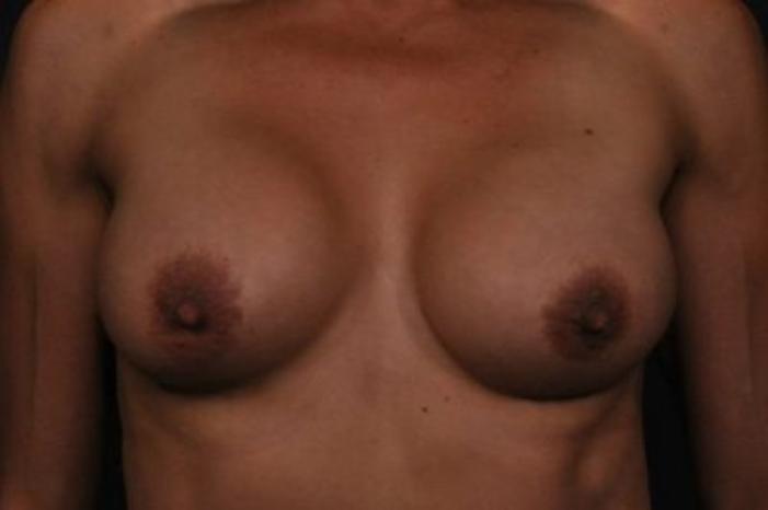 Case #1264 – Breast Augmentation