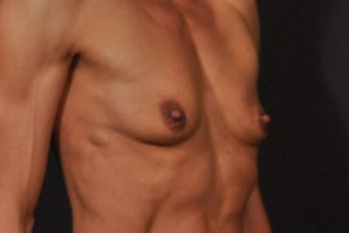 Case #1264 – Breast Augmentation