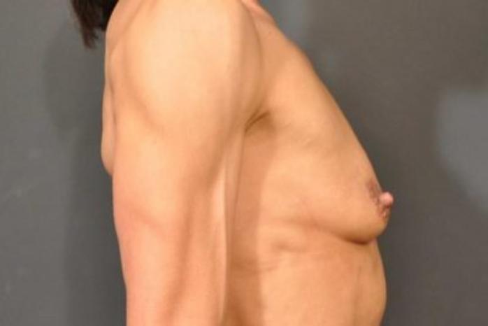 Case #1264 – Breast Augmentation