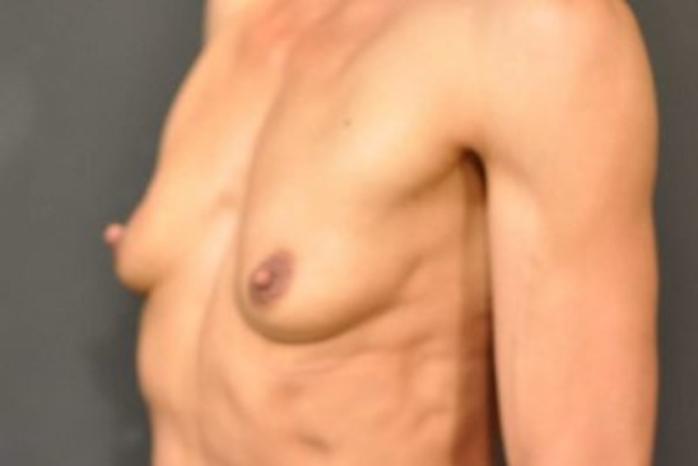 Case #1264 – Breast Augmentation