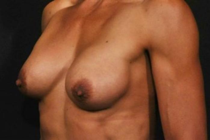 Case #1264 – Breast Augmentation