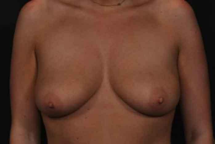 Case #1275 – Breast Lift