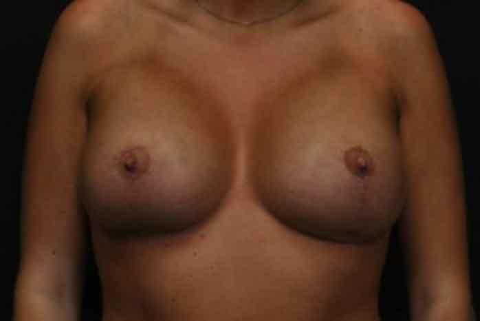 Case #1275 – Breast Lift