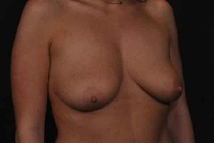 Case #1275 – Breast Lift