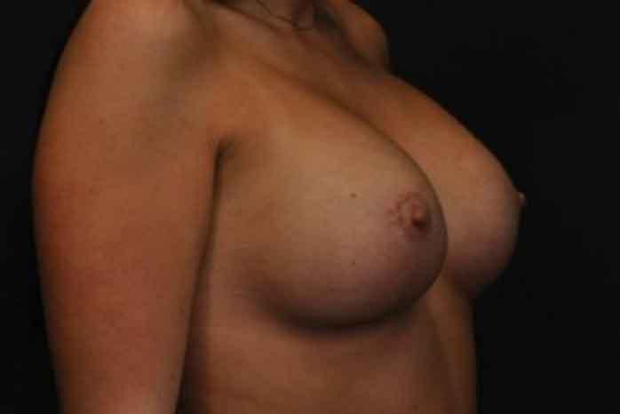 Case #1275 – Breast Lift