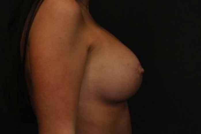 Case #1275 – Breast Lift