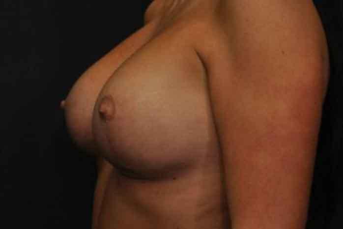 Case #1275 – Breast Lift