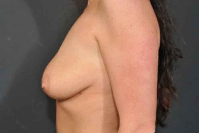 Case #1275 – Breast Lift