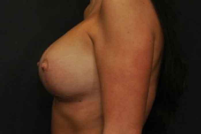 Case #1275 – Breast Lift