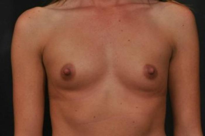 Case #1287 – Breast Augmentation