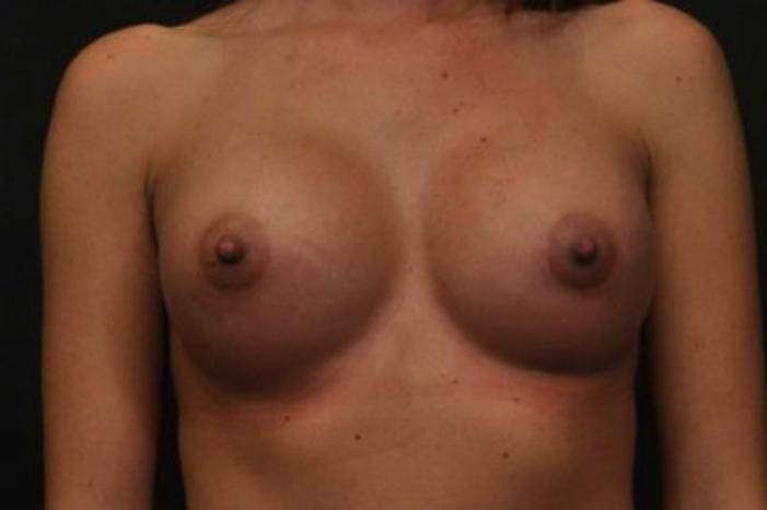 Case #1287 – Breast Augmentation