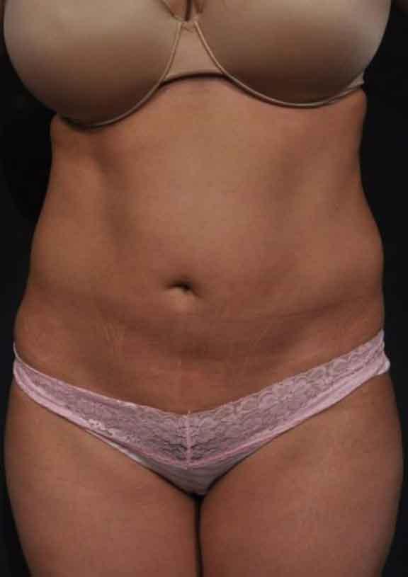 Case #128 – SmartLipo