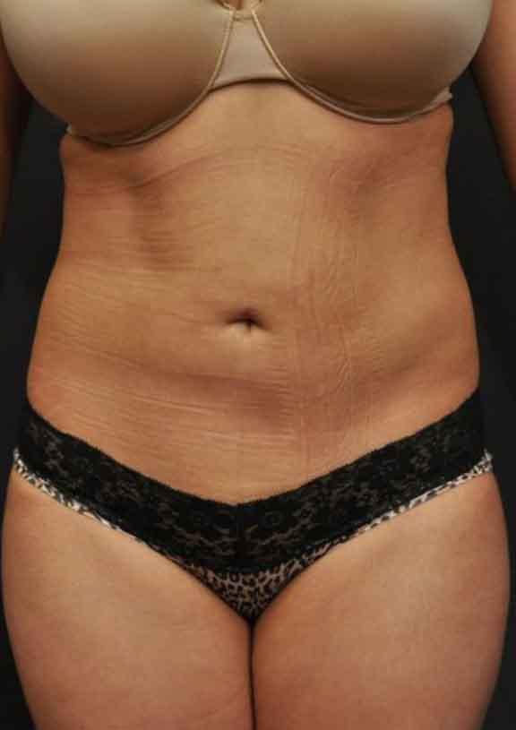 Case #128 – SmartLipo