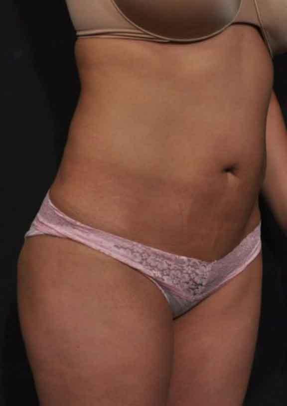 Case #128 – SmartLipo