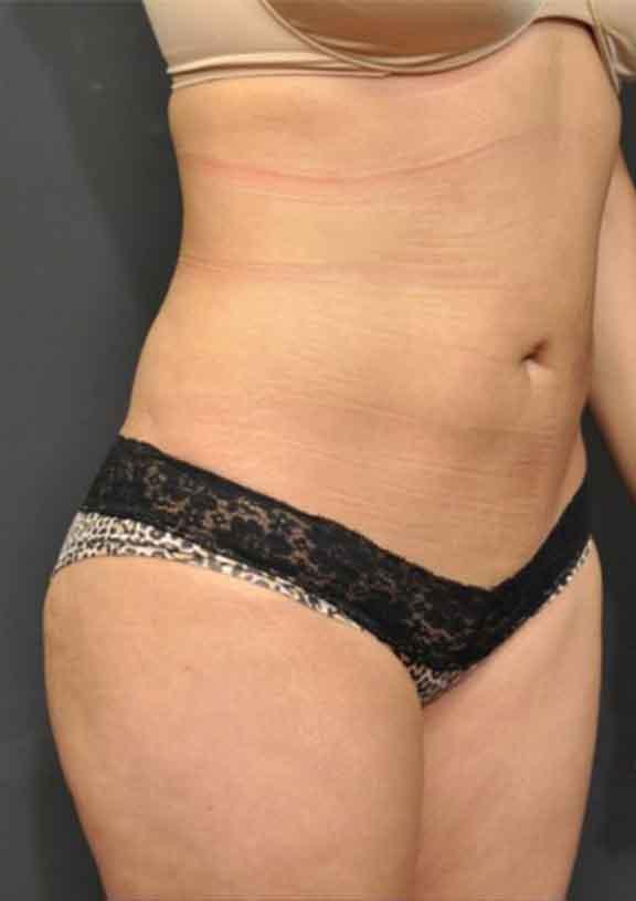 Case #128 – SmartLipo