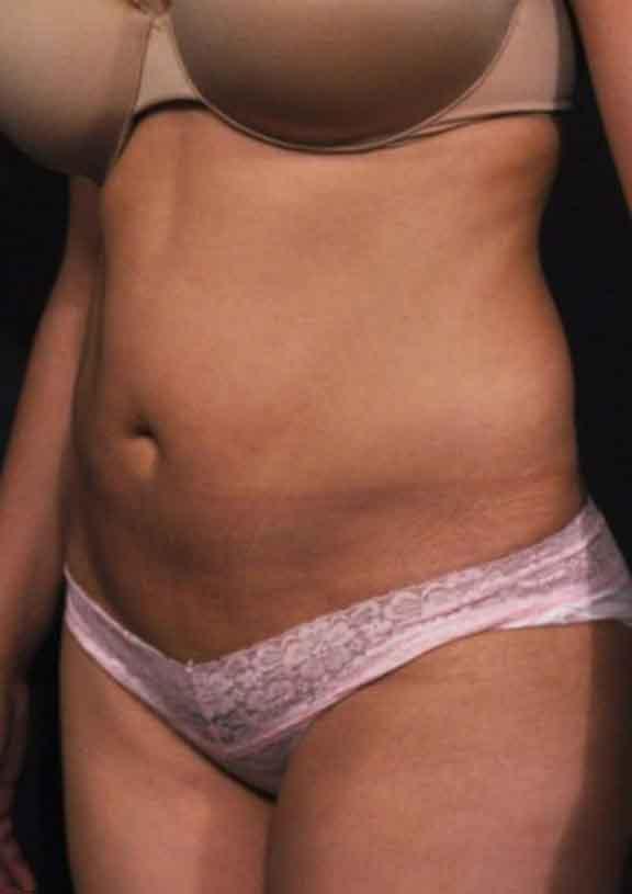 Case #128 – SmartLipo