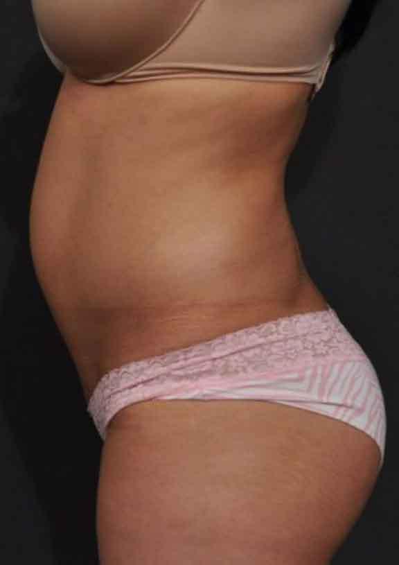 Case #128 – SmartLipo