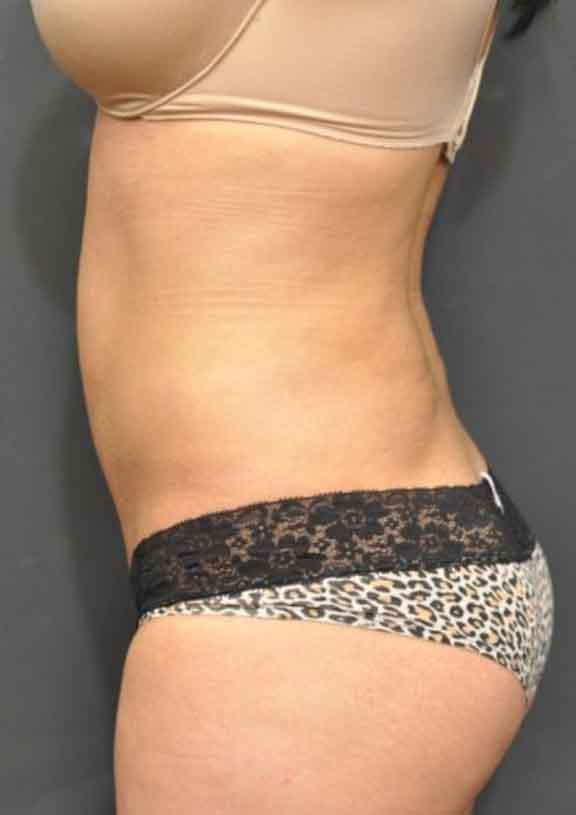 Case #128 – SmartLipo
