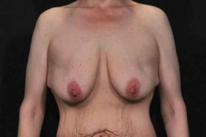 Case #1299 – Breast Lift