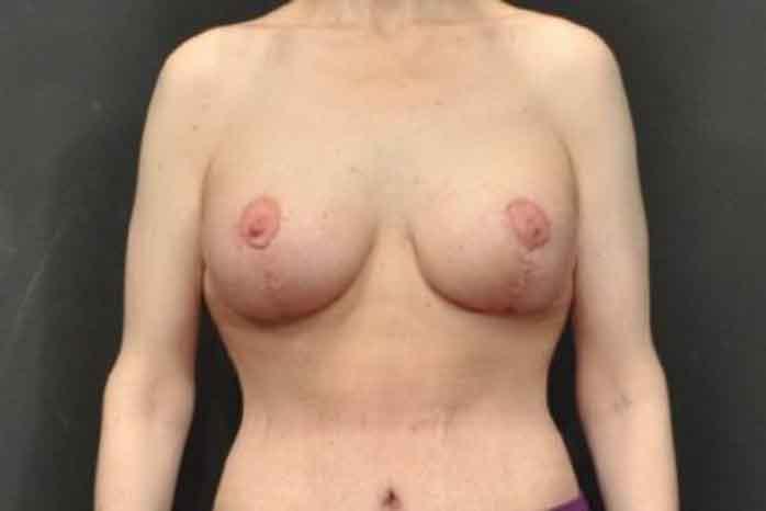 Case #1299 – Breast Lift