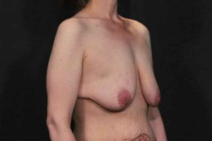 Case #1299 – Breast Lift
