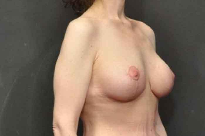 Case #1299 – Breast Lift