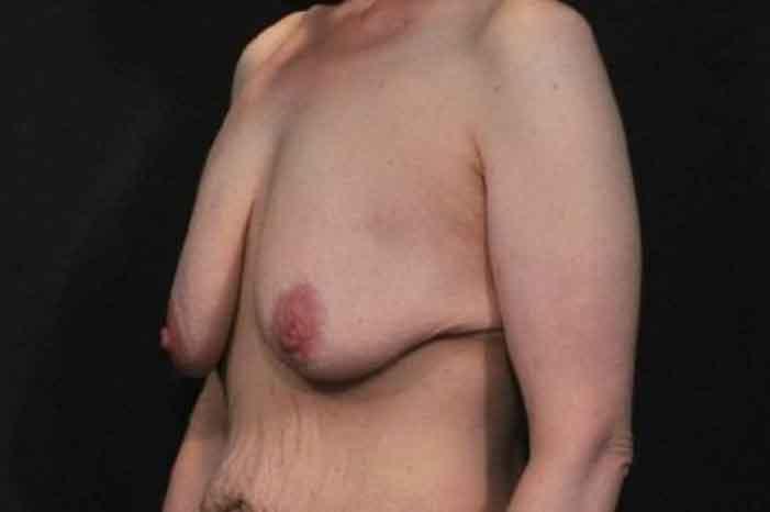 Case #1299 – Breast Lift
