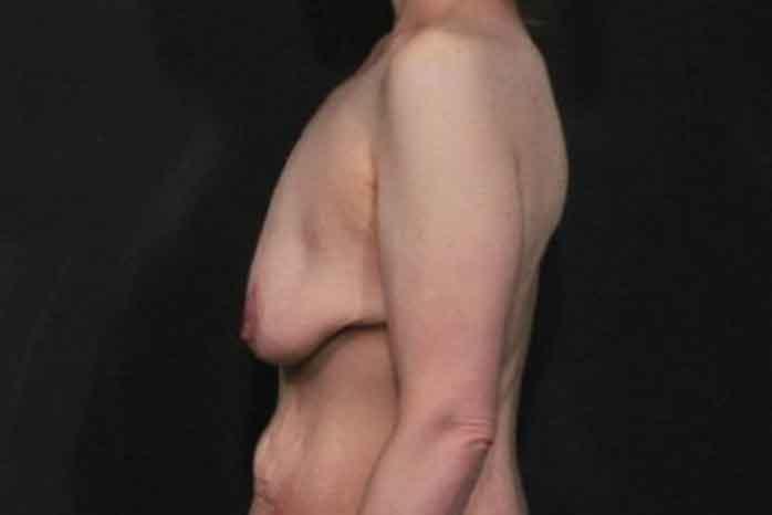 Case #1299 – Breast Lift