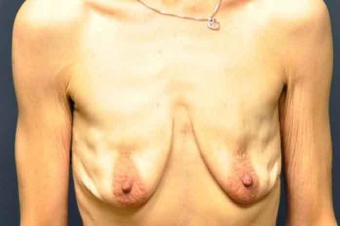 Case #1313 – Breast Lift