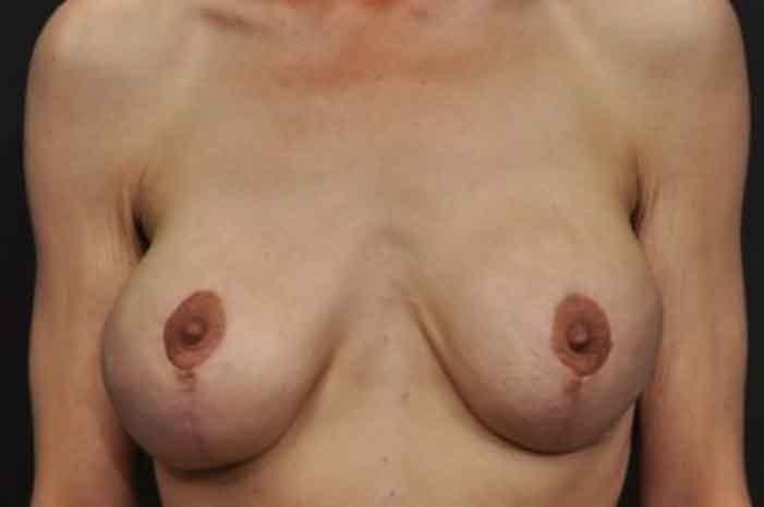 Case #1313 – Breast Lift