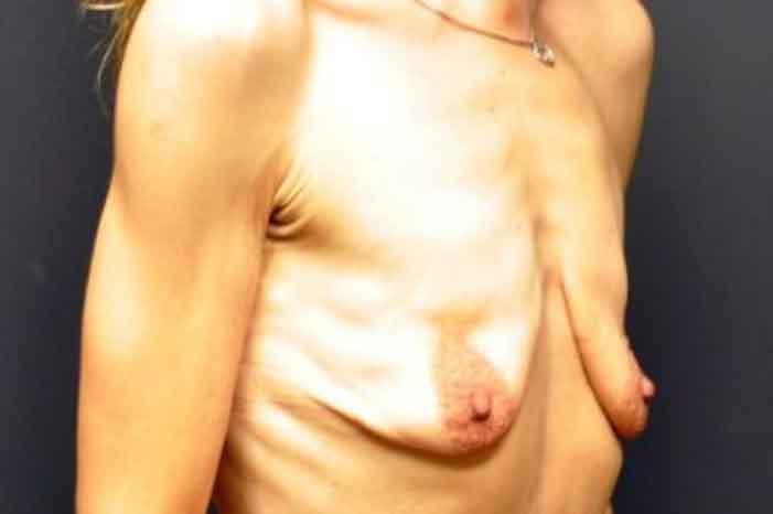 Case #1313 – Breast Lift