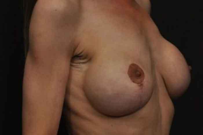 Case #1313 – Breast Lift