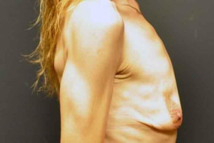 Case #1313 – Breast Lift