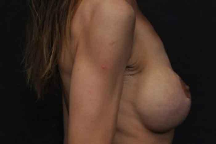 Case #1313 – Breast Lift