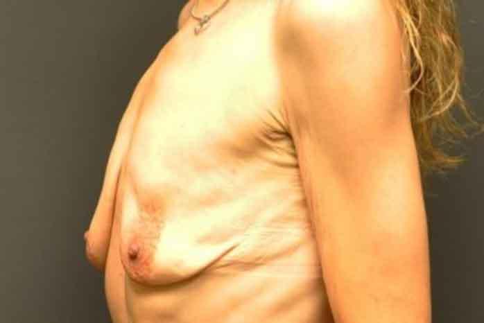 Case #1313 – Breast Lift