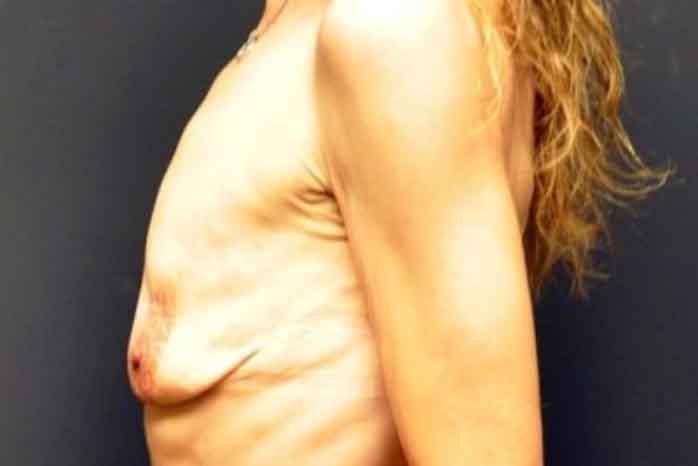 Case #1313 – Breast Lift