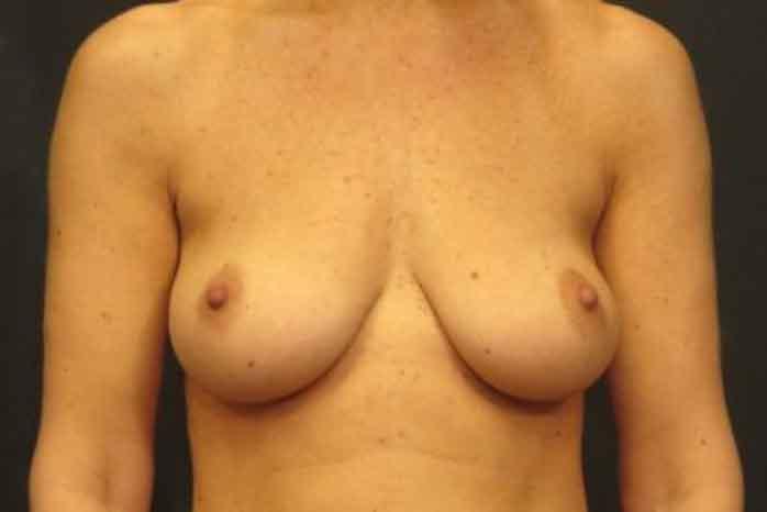 Case #1342 – Breast Lift