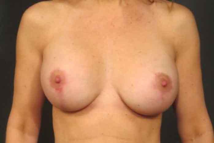 Case #1342 – Breast Lift