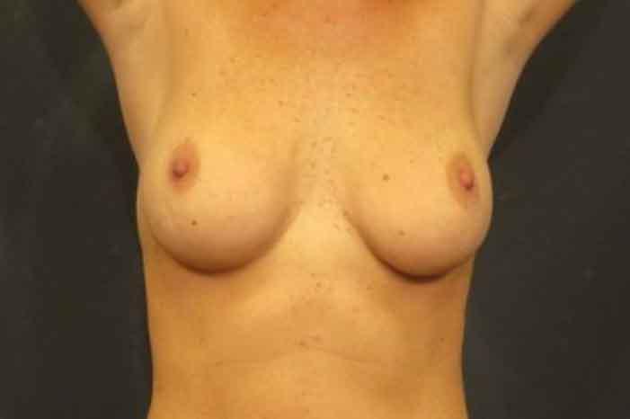 Case #1342 – Breast Lift