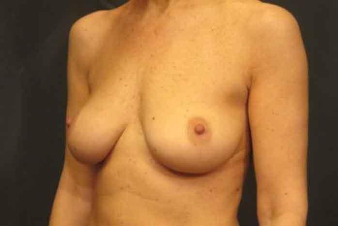 Case #1342 – Breast Lift
