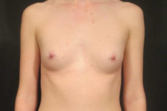 Case #1356 – Breast Augmentation