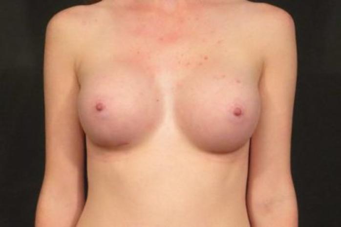 Case #1356 – Breast Augmentation